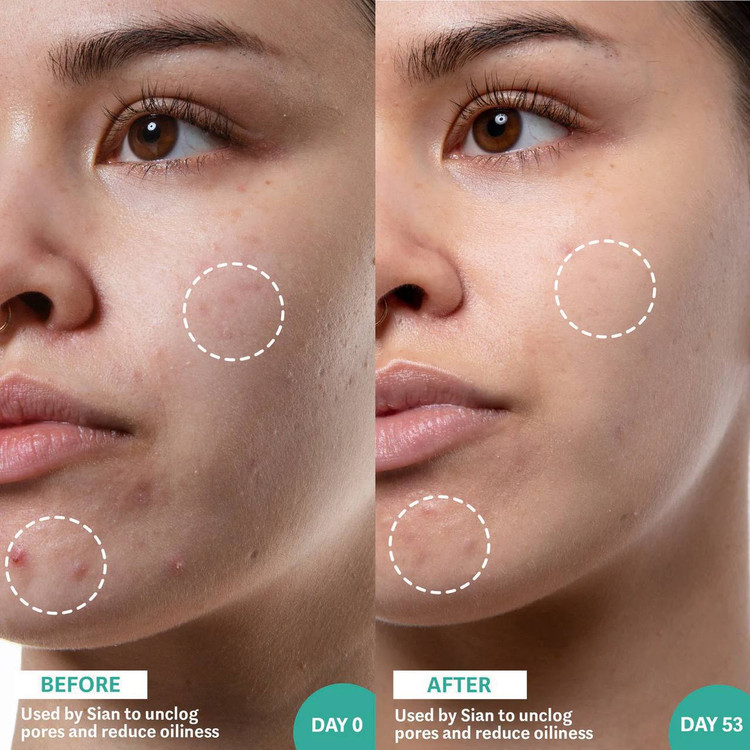 سرم ضدجوش و ضد منافذ باز by Hyram